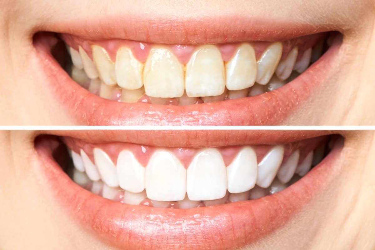 Tips for Whitening Your Teeth