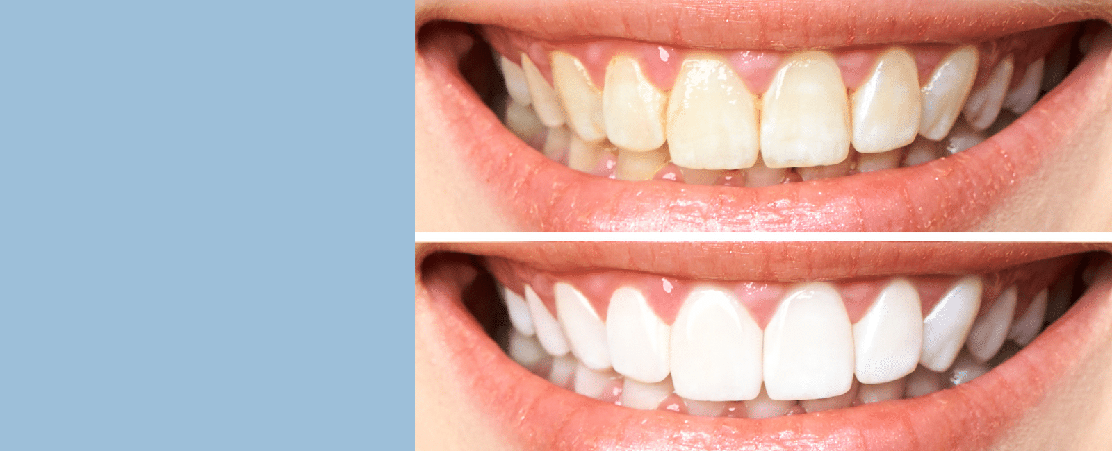 Tips for Whitening Your Teeth