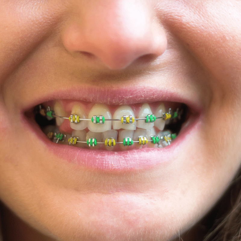 Choosing the Right Color for Your Metal Braces: A Guide for Palo Alto Patients