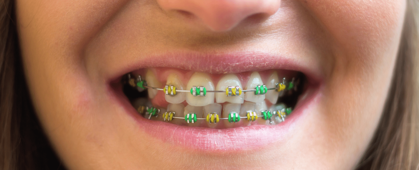 Choosing the Right Color for Your Metal Braces: A Guide for Palo Alto Patients