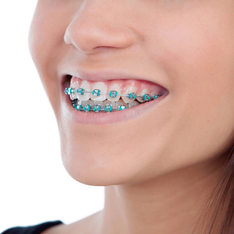 How Braces Work: A Comprehensive Guide to Straightening Your Teeth