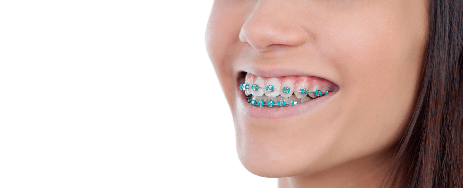 How Braces Work: A Comprehensive Guide to Straightening Your Teeth