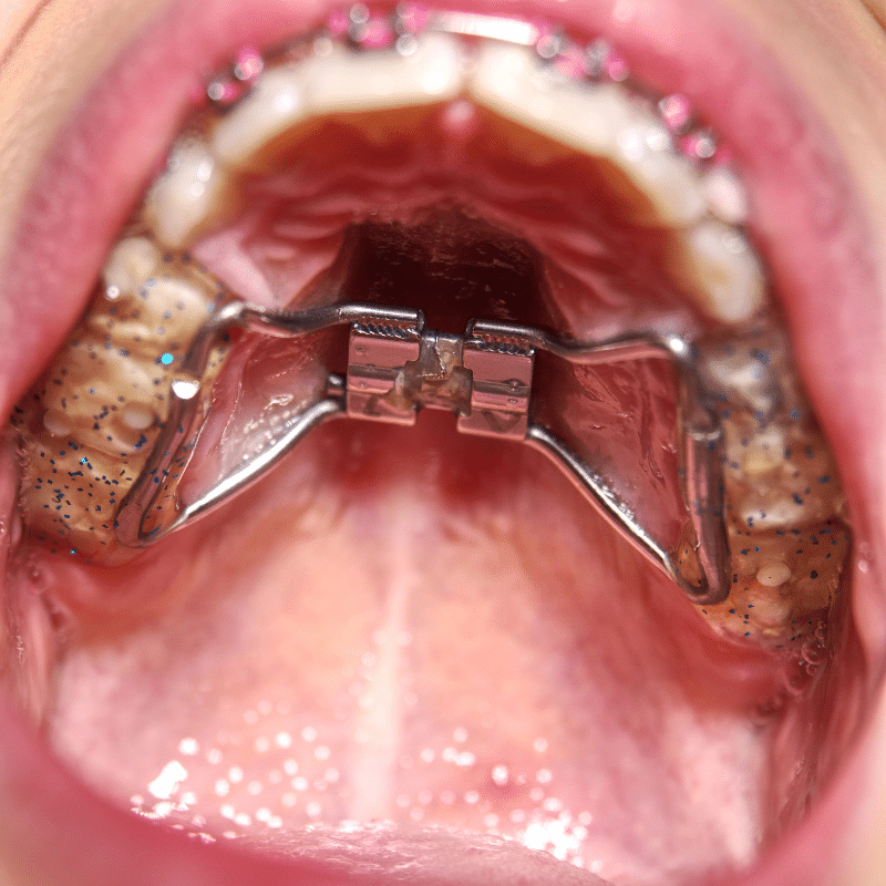 Orthodontic Expander: A Key Tool for a Healthier Smile in Palo Alto