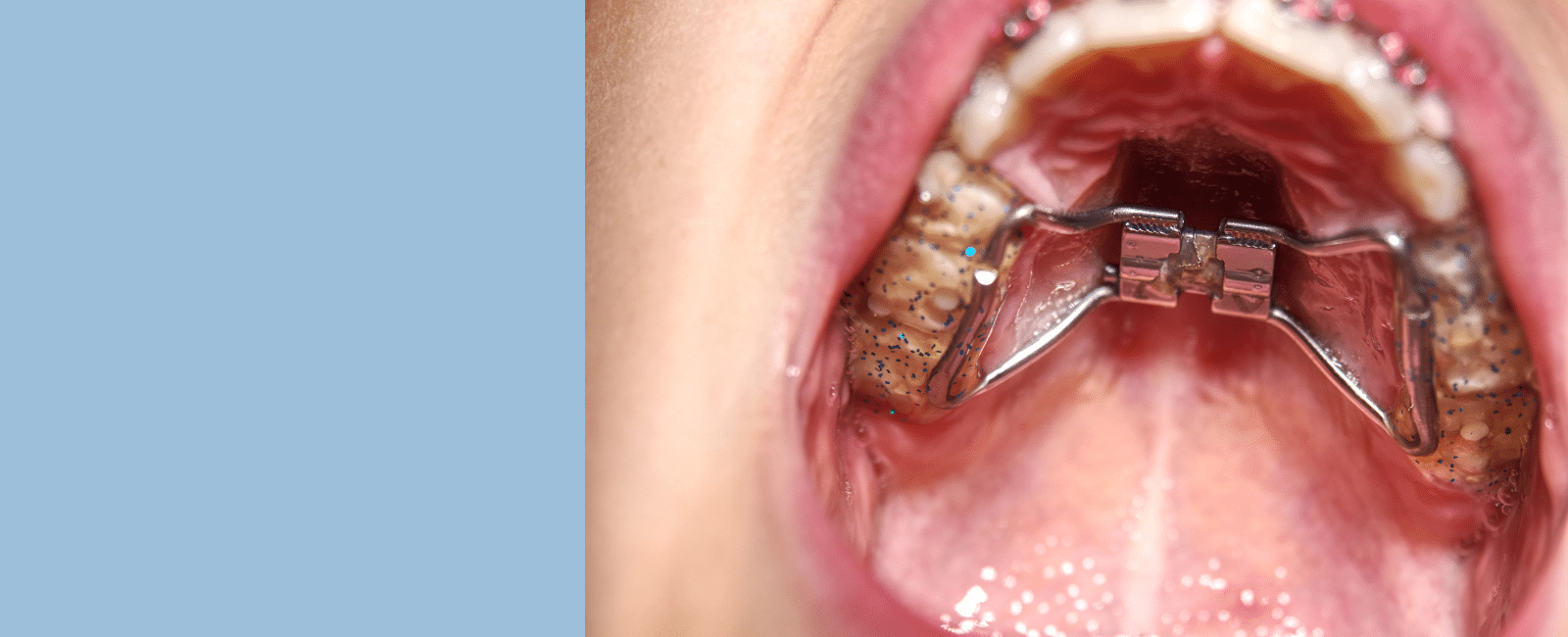 Orthodontic Expander: A Key Tool for a Healthier Smile in Palo Alto