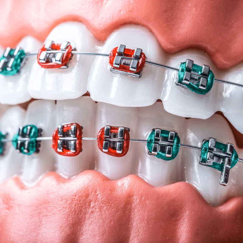 Understanding the Cost of Braces in Palo Alto