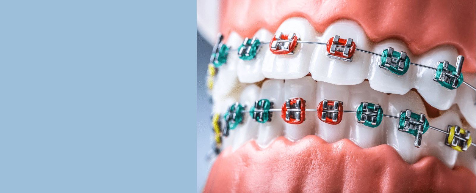 Understanding the Cost of Braces in Palo Alto