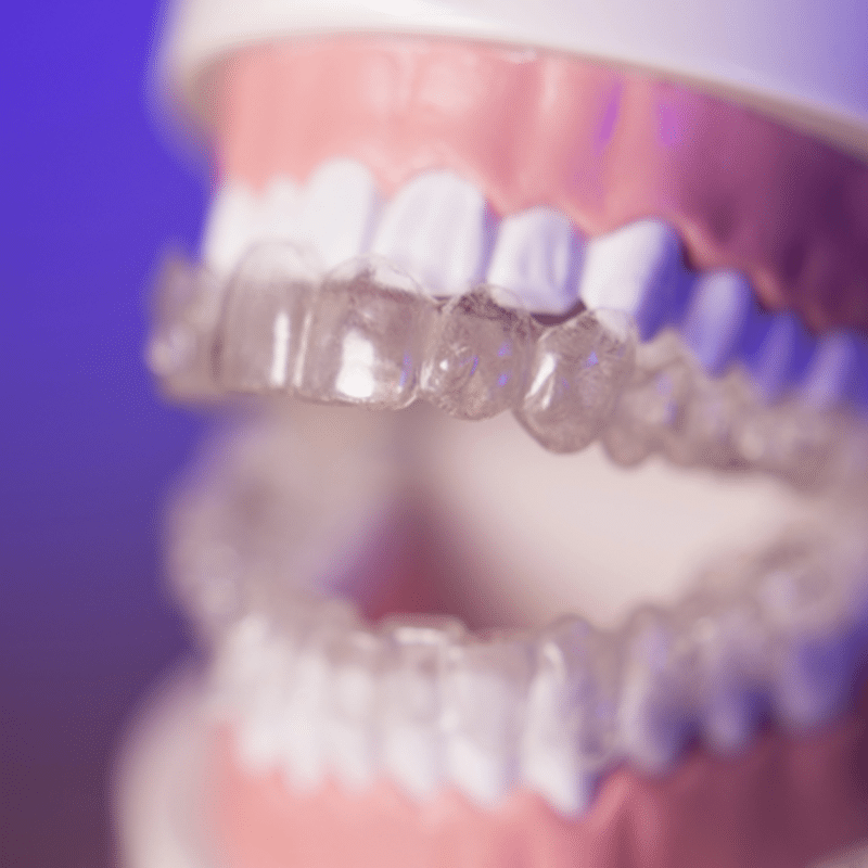 Invisalign Cost in Palo Alto: What You Need to Know from Your Local Orthodontists