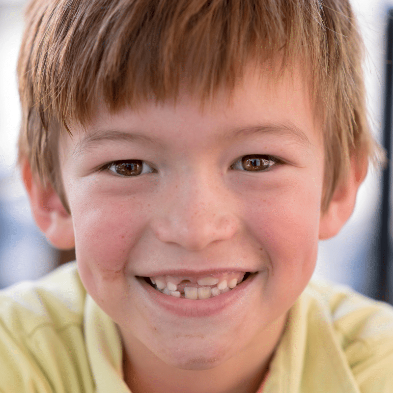 Reverse Pull Headgear (Facemask): A Powerful Tool for Early Orthodontic Treatment in Palo Alto