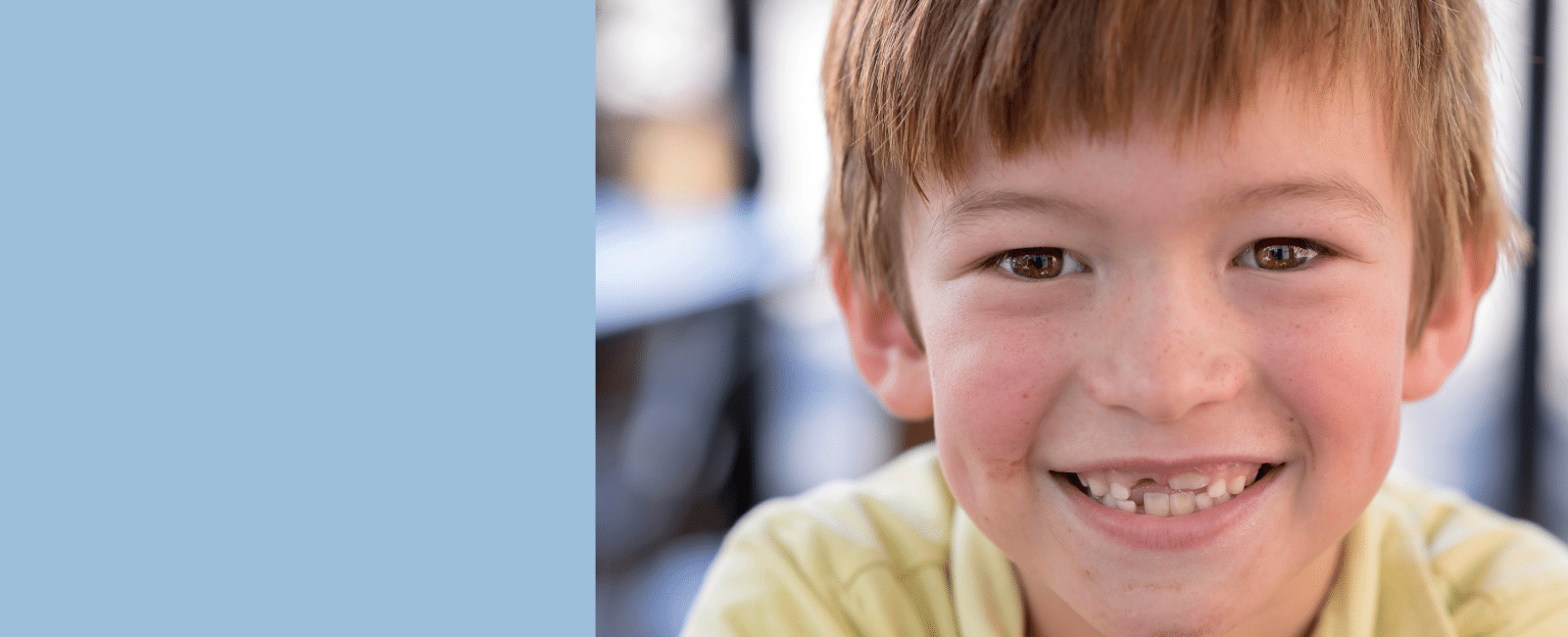 Reverse Pull Headgear - A Powerful Tool for Early Orthodontic Treatment in Palo Alto
