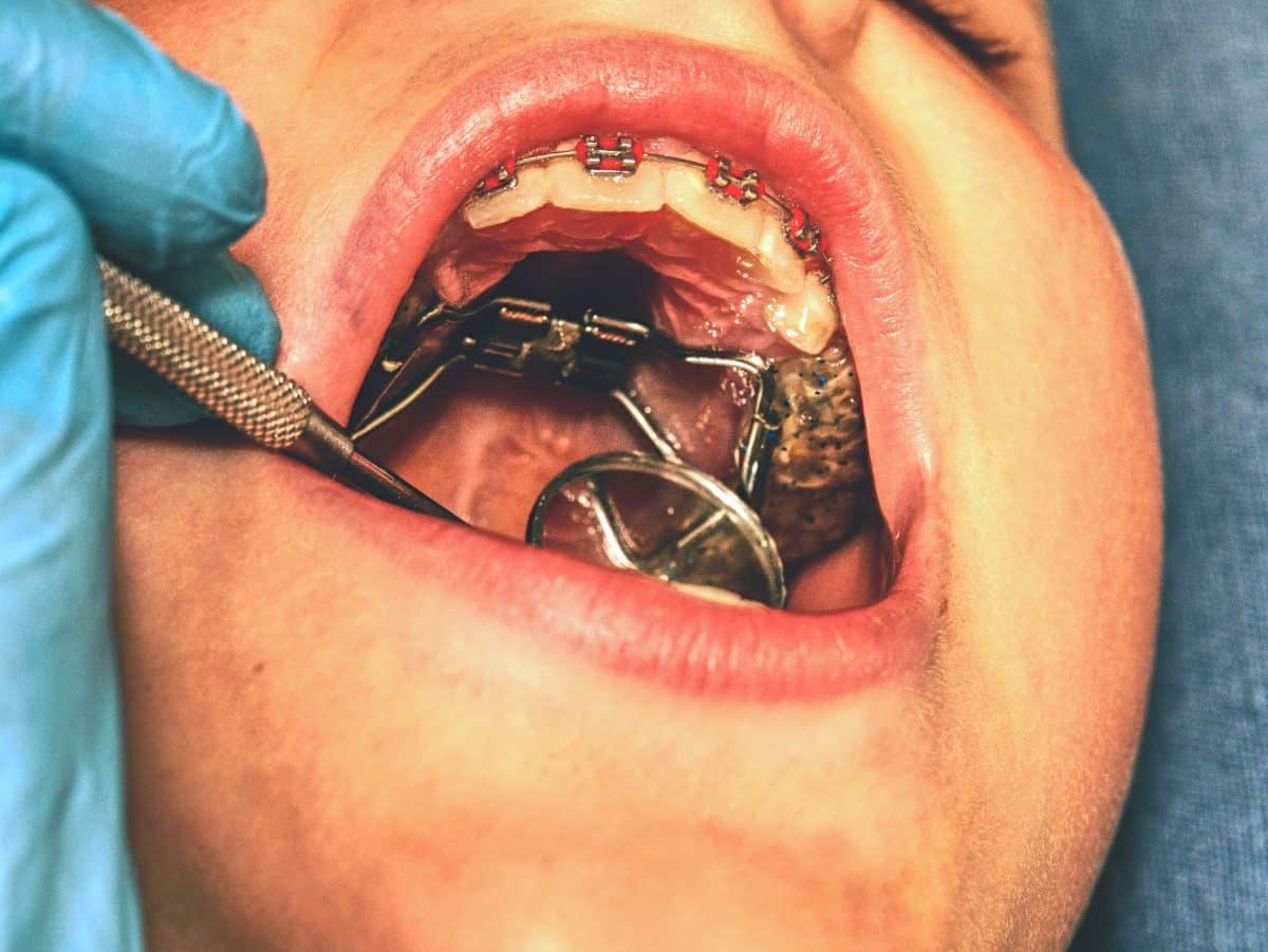 IPE vs. RPE: Which Palatal Expander Is Right for Your Child?