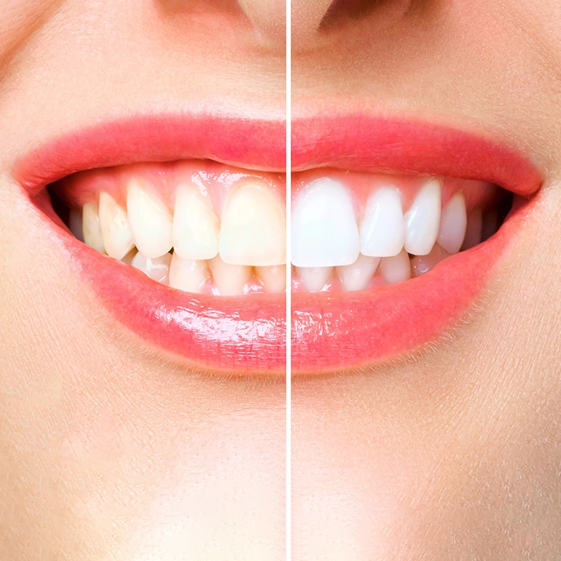 Can You Do Whitening with Braces? Here’s What You Need to Know