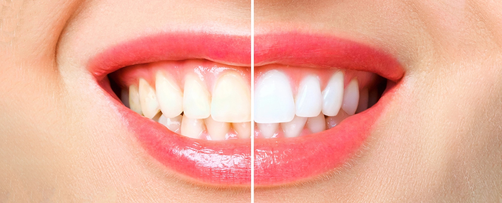Can You Do Whitening with Braces? Here's What You Need to Know
