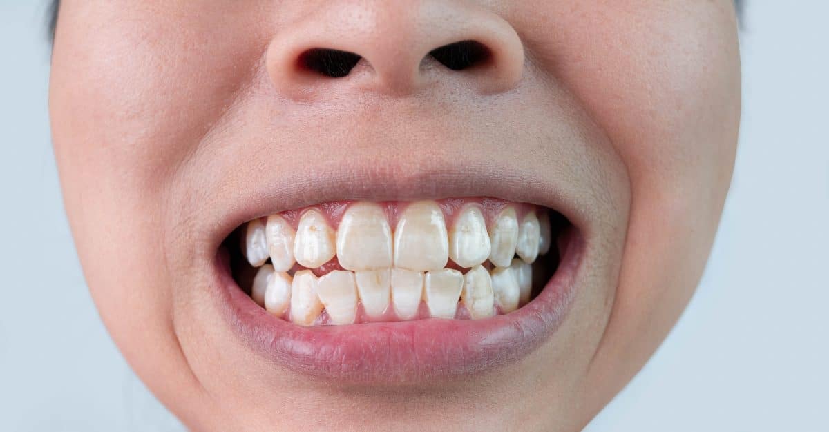 How to Prevent White Spot Lesions While Wearing Braces in Palo Alto