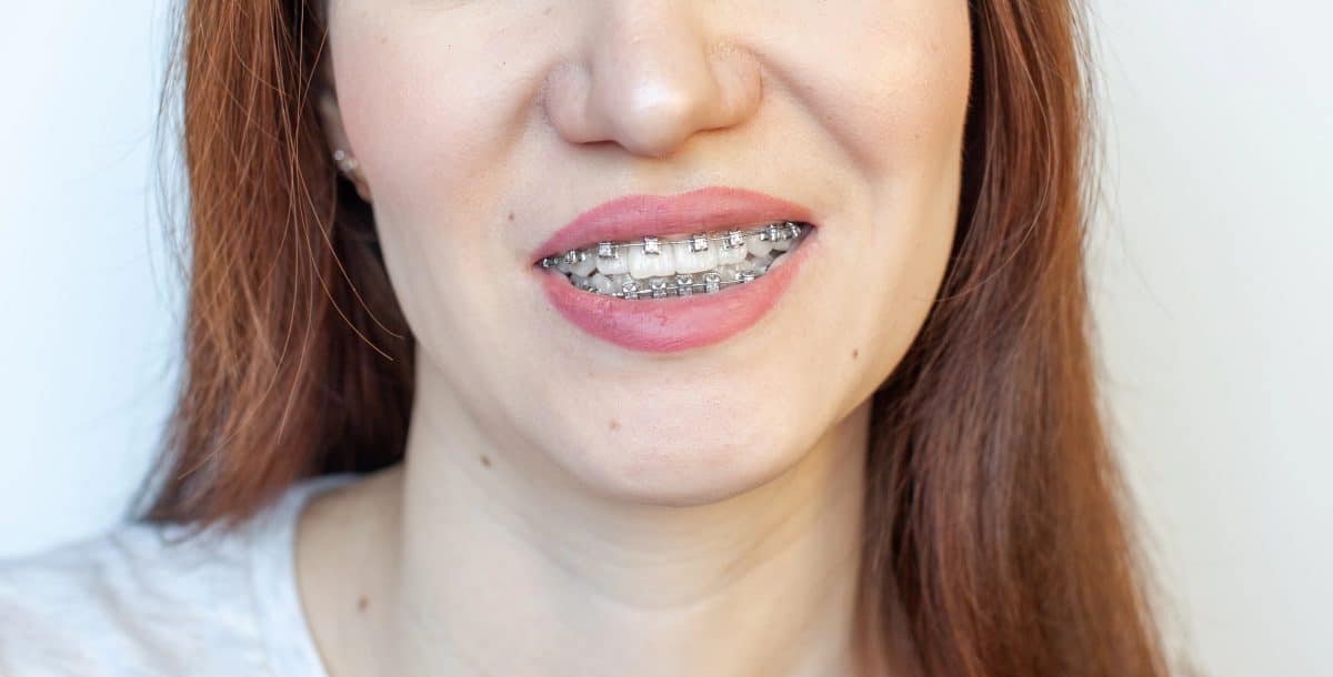 Understanding MARPE (Mini Screw Assisted Rapid Palatal Expander) in Palo Alto