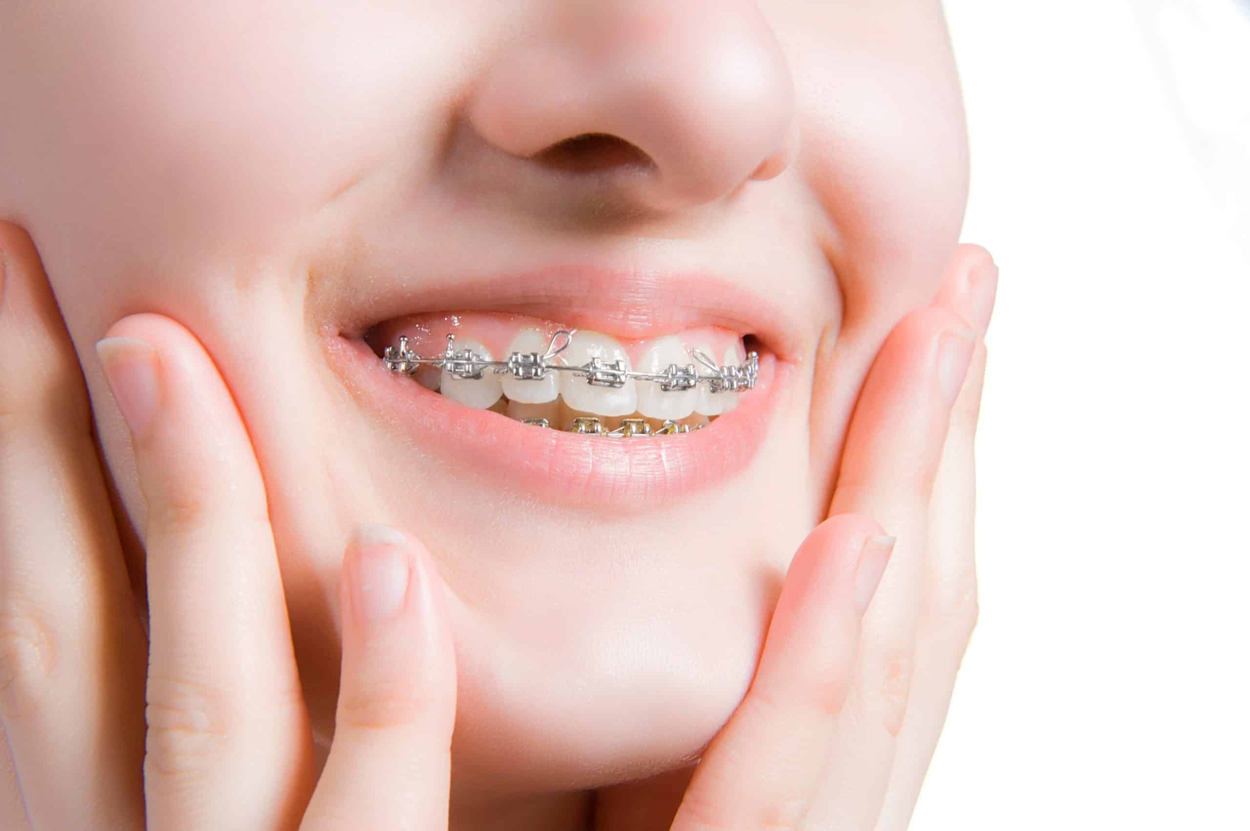 How Broken Brackets Delay Your Braces Treatment