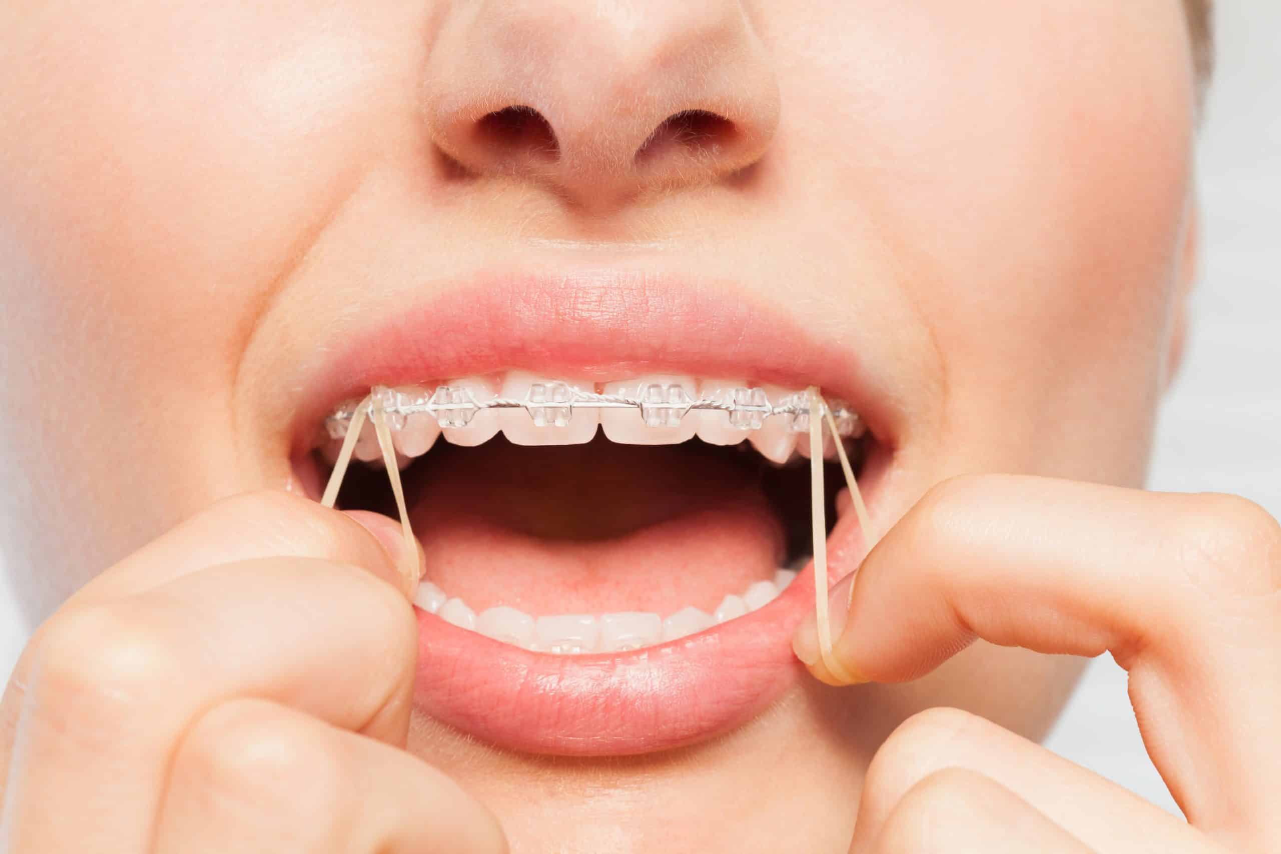 What Happens If You Don’t Wear Elastics?